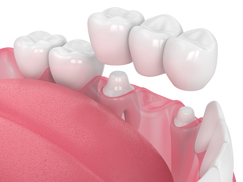 Ceramic Crowns And Bridges Fixing