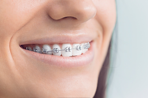 Dental Braces Fixing