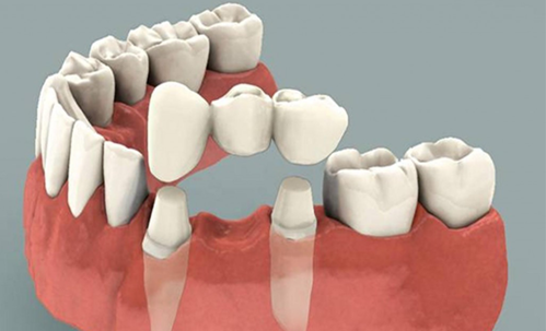 Complete/partial Dentures Fixing