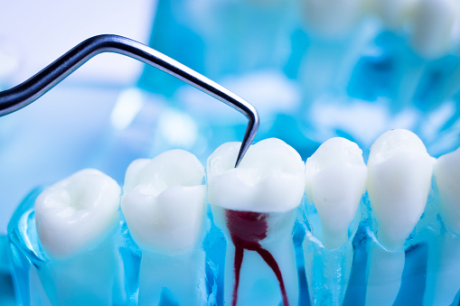 Root Canal Treatments